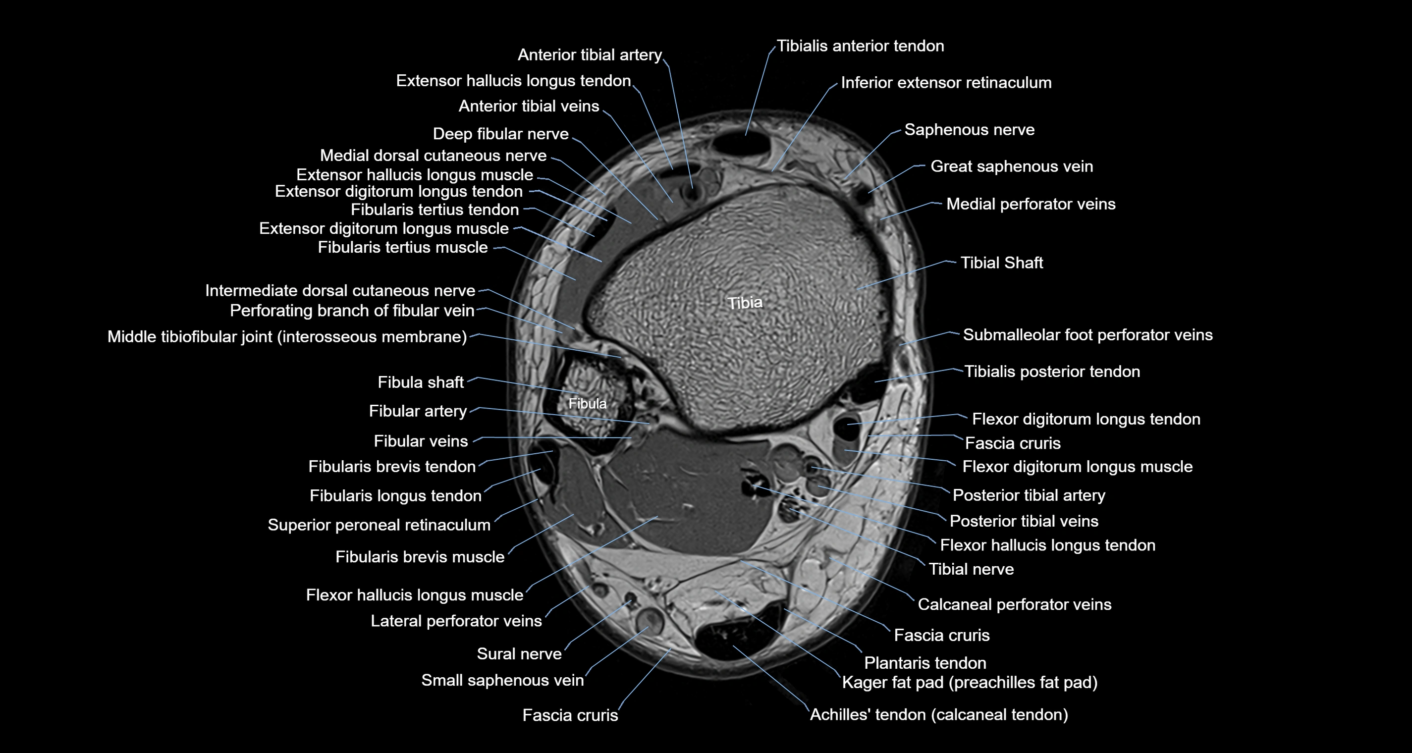 Ankle axial anatomy 3T MRI images -img-10001-00006.webp